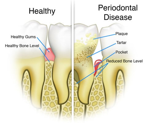 Gum Disease Treatment Melbourne