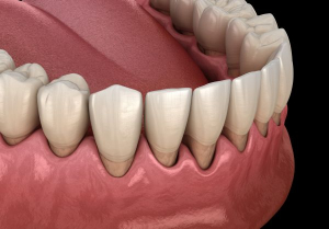 Receding Gums Receding Gums Treatment